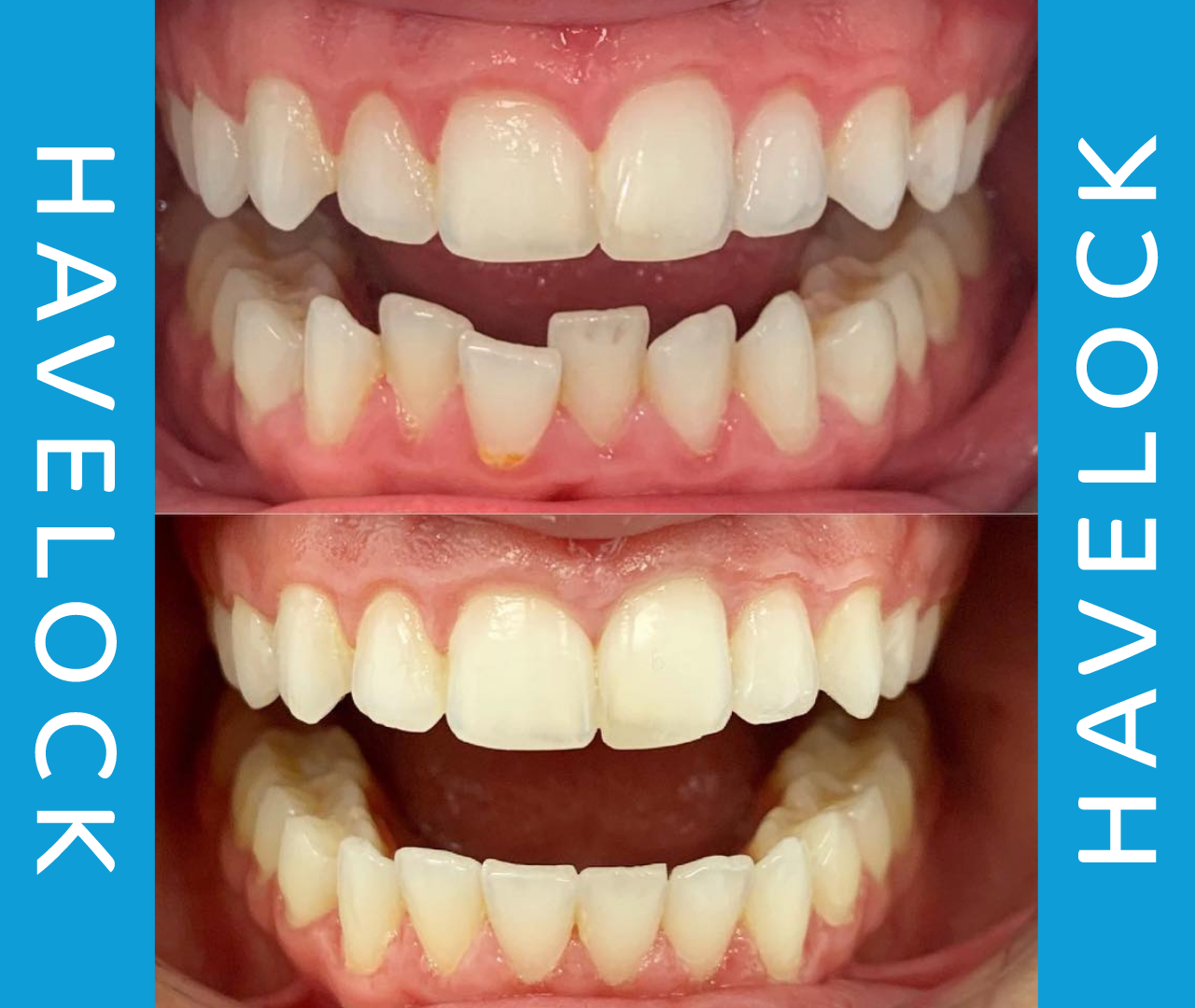 Invisalign Teeth Straightening Dental Treatment Whitby Scarborough North Yorkshire Havelock Dental Practice