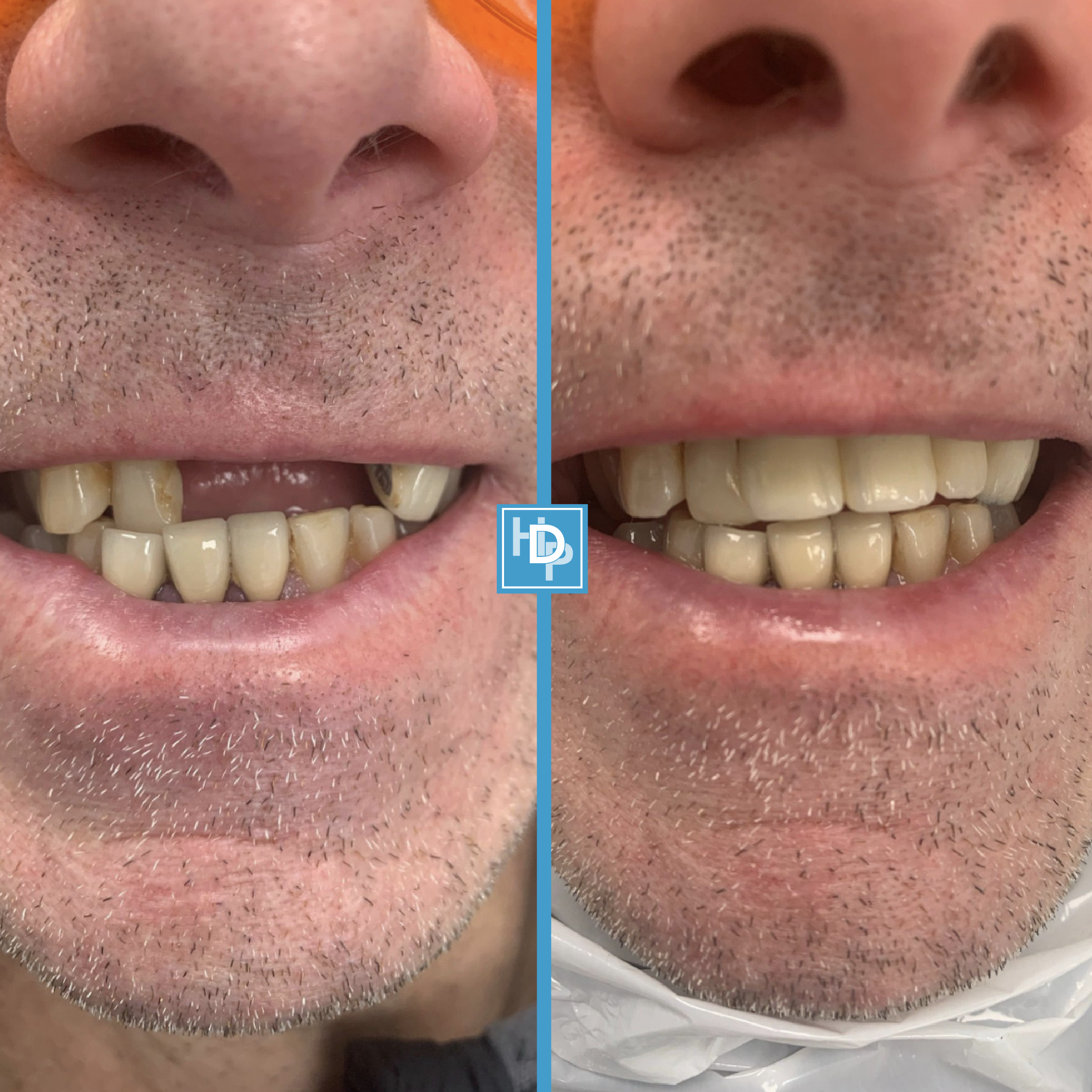 Havelock Dental Implants Clinic Smile Makeover Scarborough Whitby North Yorkshire Implant