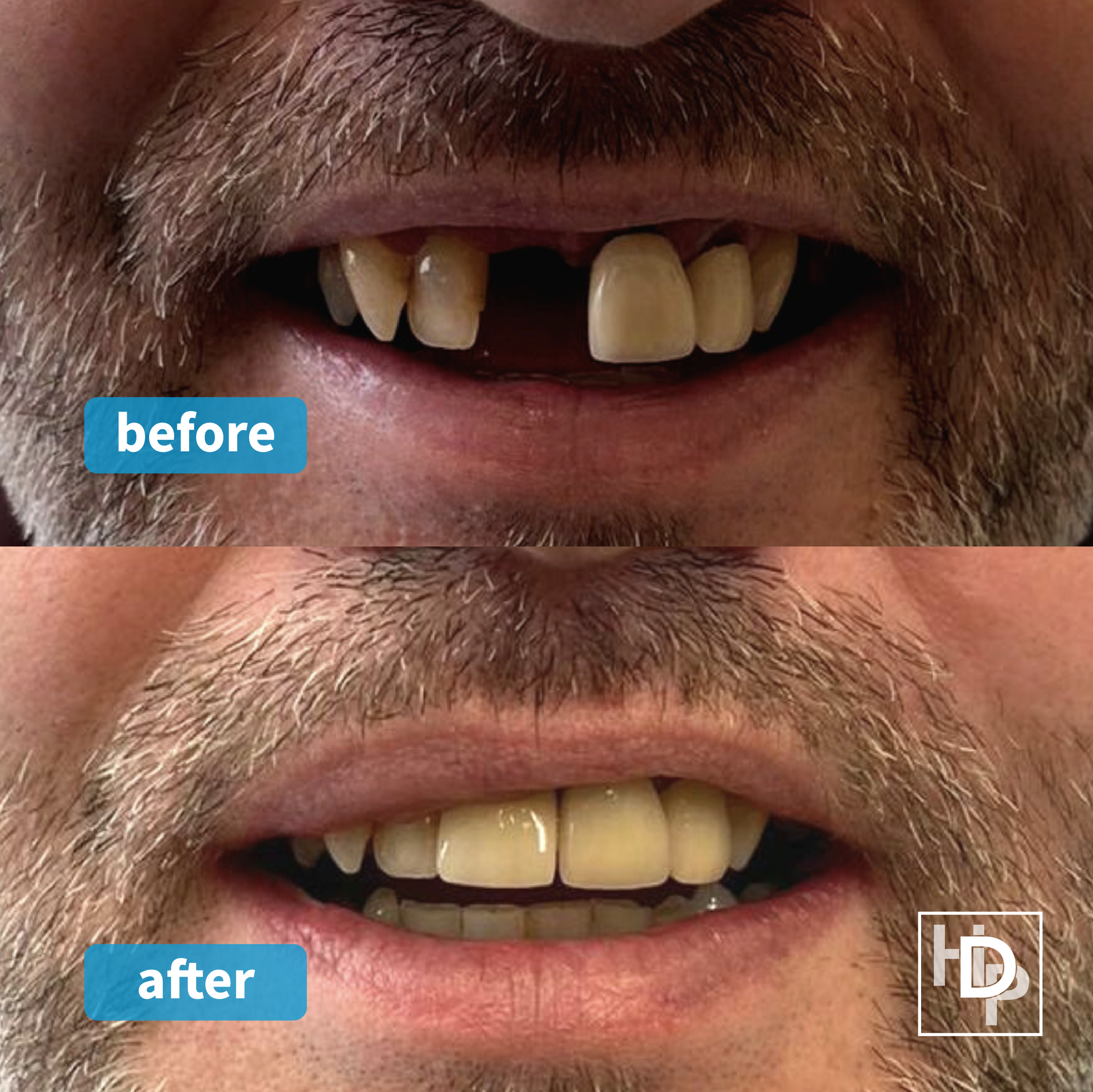 Havelock Dental Implants Clinic Smile Makeover Scarborough Whitby North Yorkshire Implant