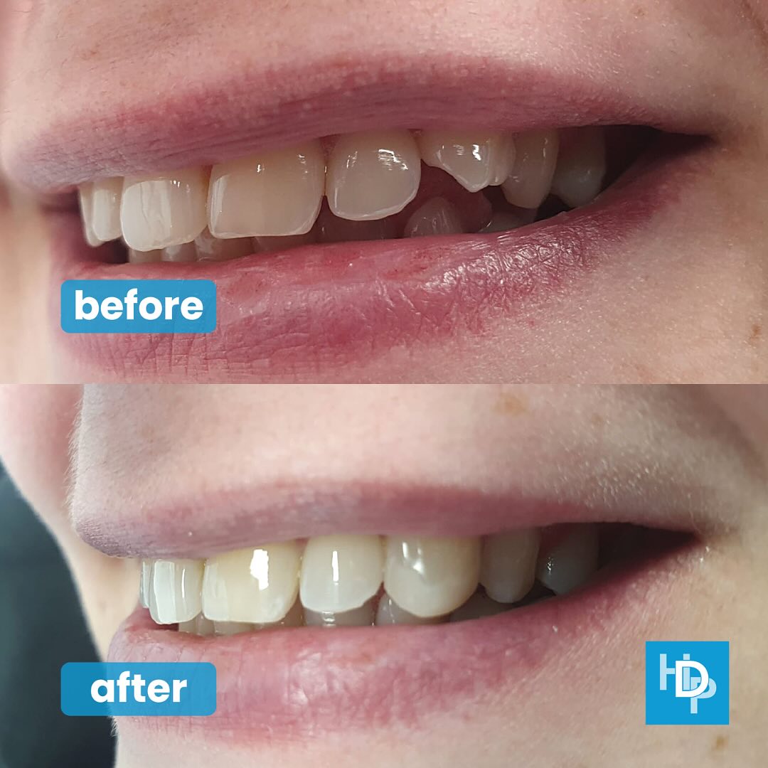 Composite Bonding whitby Scarborough Smile Makeover Dentist