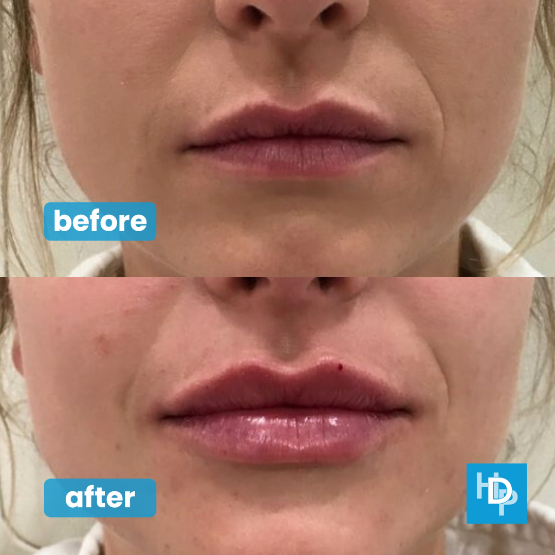 Dermal Lip Filler Treatment Facial Aesthetics Whitby Scarborough